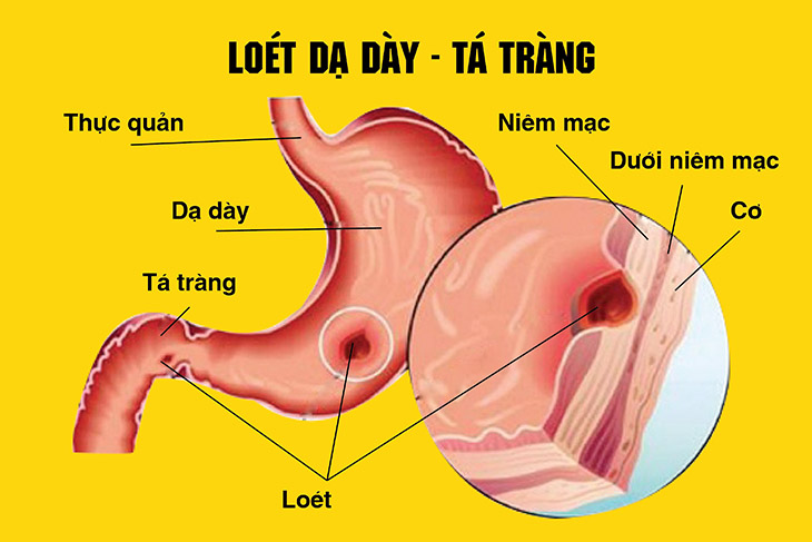 loét dạ dày tá tràng 