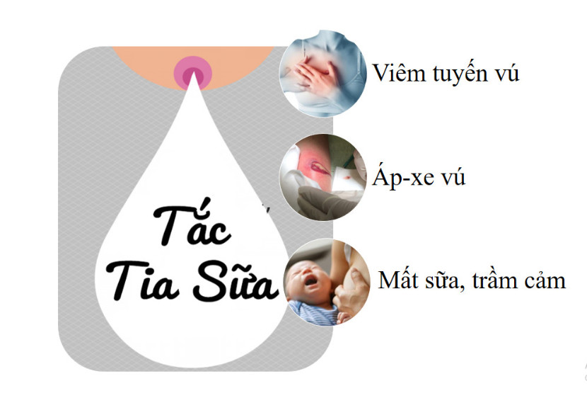 Hậu quả của tắc tia sữa