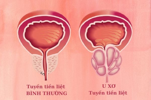 U xơ tiền liệt tuyến